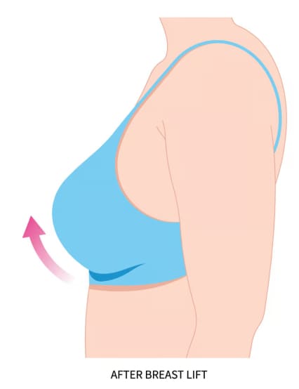 http://www.phoenixcosmeticcentre.com/breast-lift